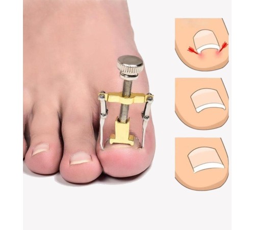 Batık Tırnak Düzeltme Aleti